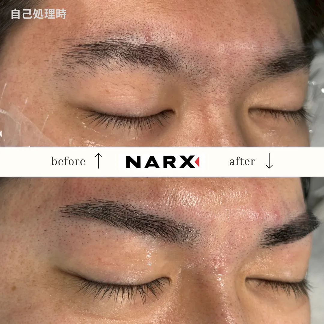 メンズ眉毛 光脱毛のビフォーアフター例 7