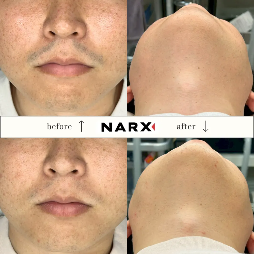 NARX ヒゲ脱毛 ビフォーアフター実例 1