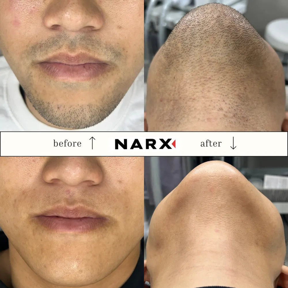 NARX ヒゲ脱毛 ビフォーアフター実例 2
