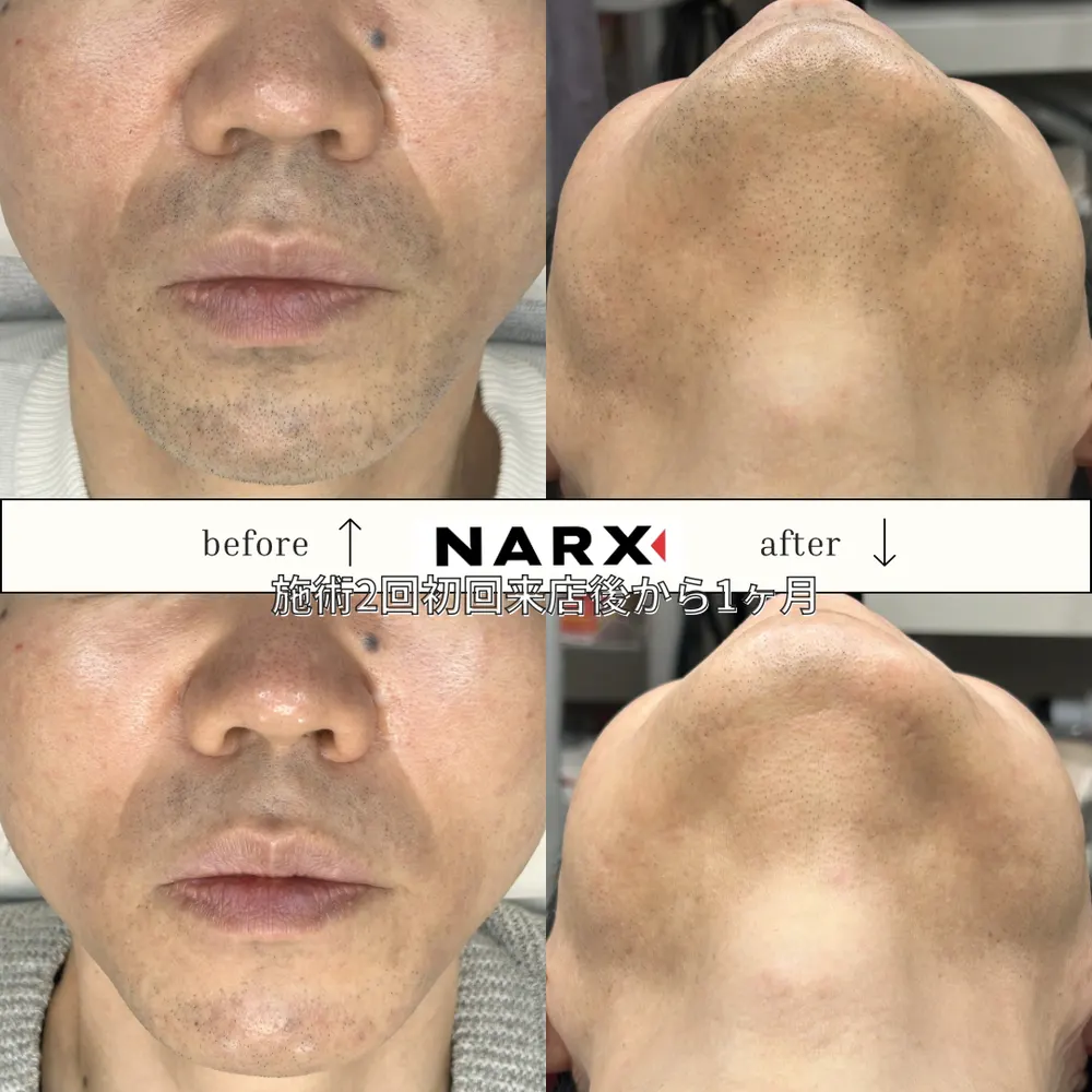 NARX ヒゲ脱毛 ビフォーアフター実例 3