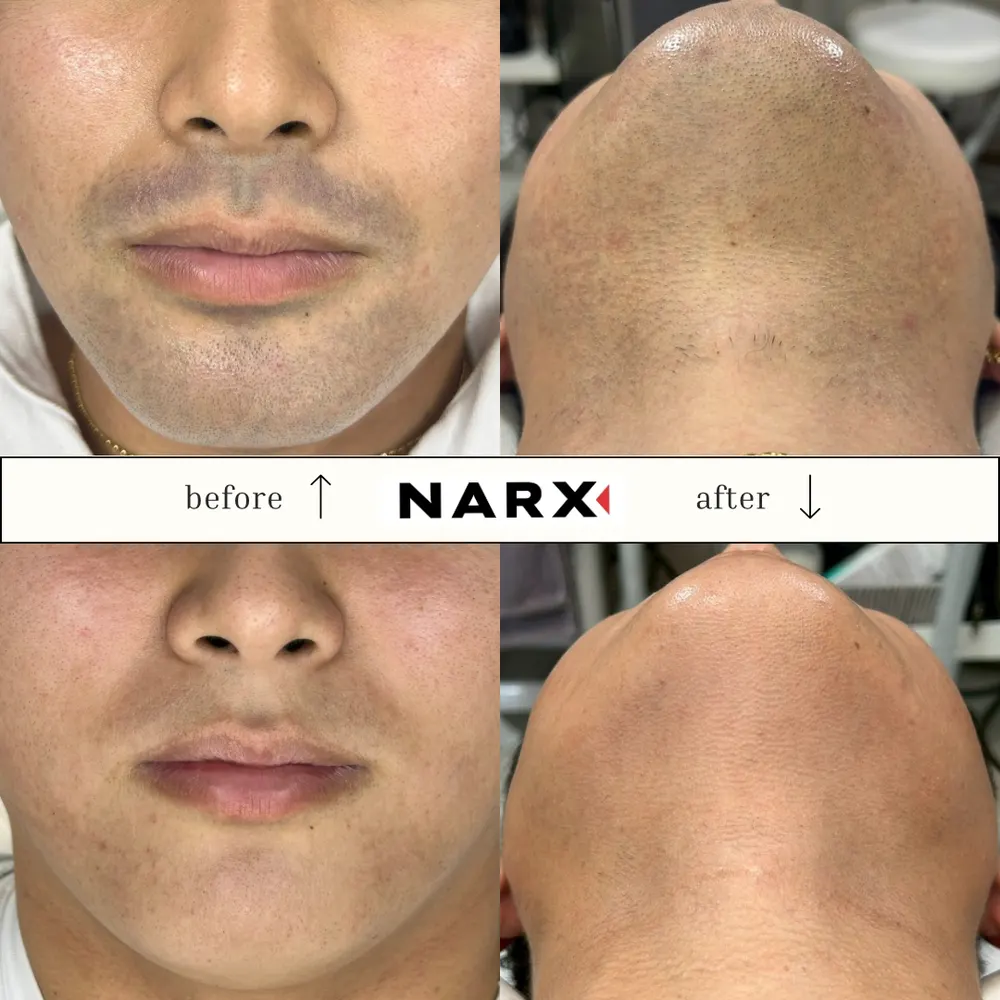 NARX ヒゲ脱毛 ビフォーアフター実例 4