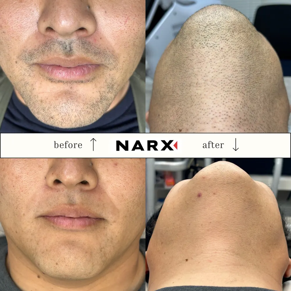 NARX ヒゲ脱毛 ビフォーアフター実例 5
