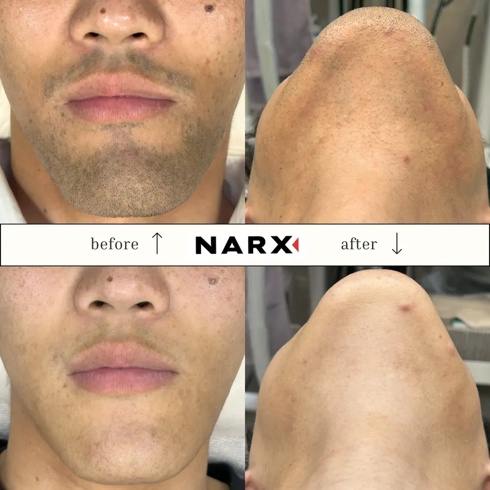 NARX ヒゲ脱毛 ビフォーアフター実例 6