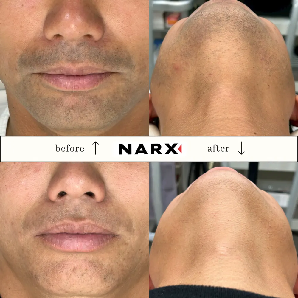 NARX ヒゲ脱毛 ビフォーアフター実例 7