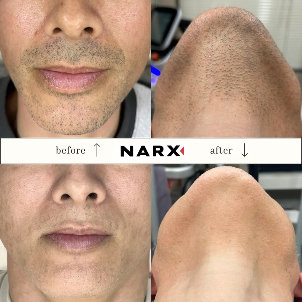 NARX ヒゲ脱毛 ビフォーアフター実例 8