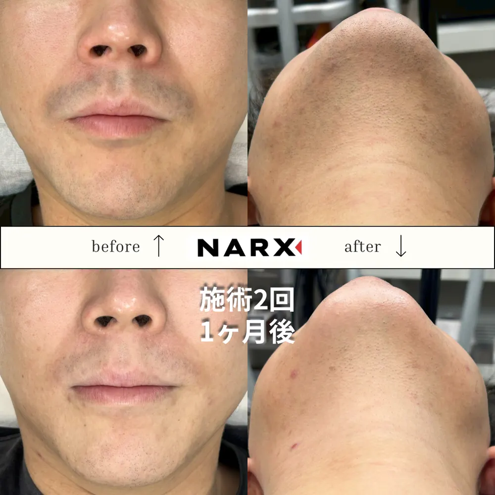 NARX ヒゲ脱毛 ビフォーアフター実例 9