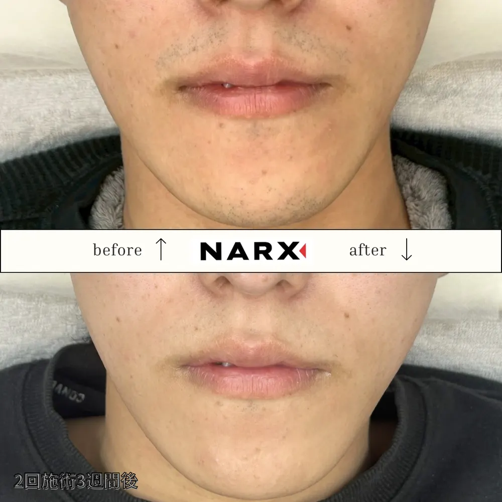 NARX ヒゲ脱毛 ビフォーアフター実例 10