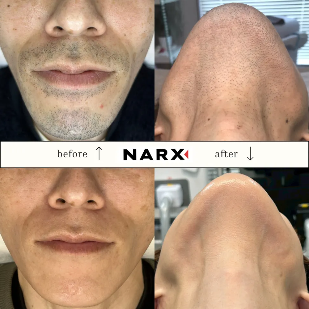 NARX ヒゲ脱毛 ビフォーアフター実例 11