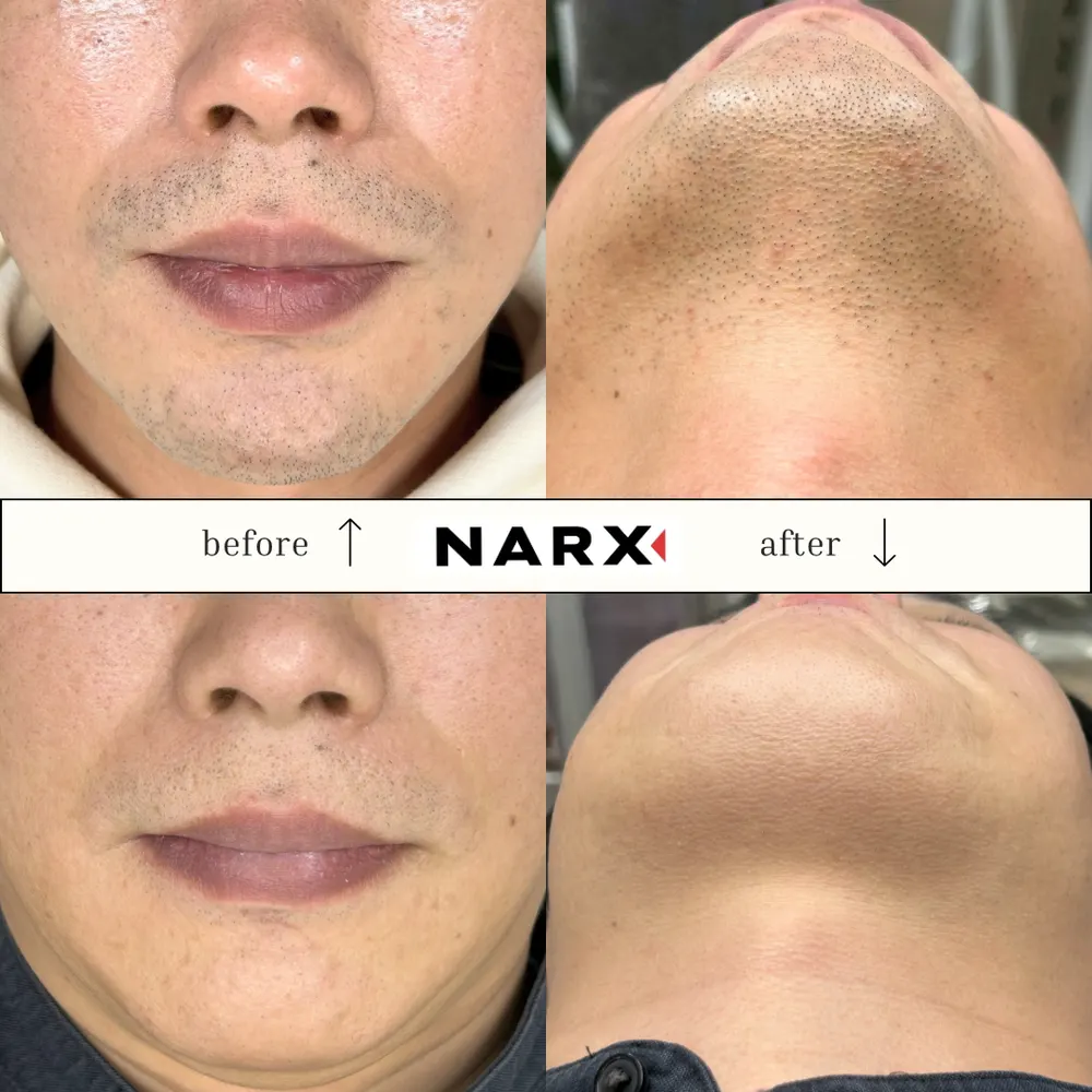 NARX ヒゲ脱毛 ビフォーアフター実例 12